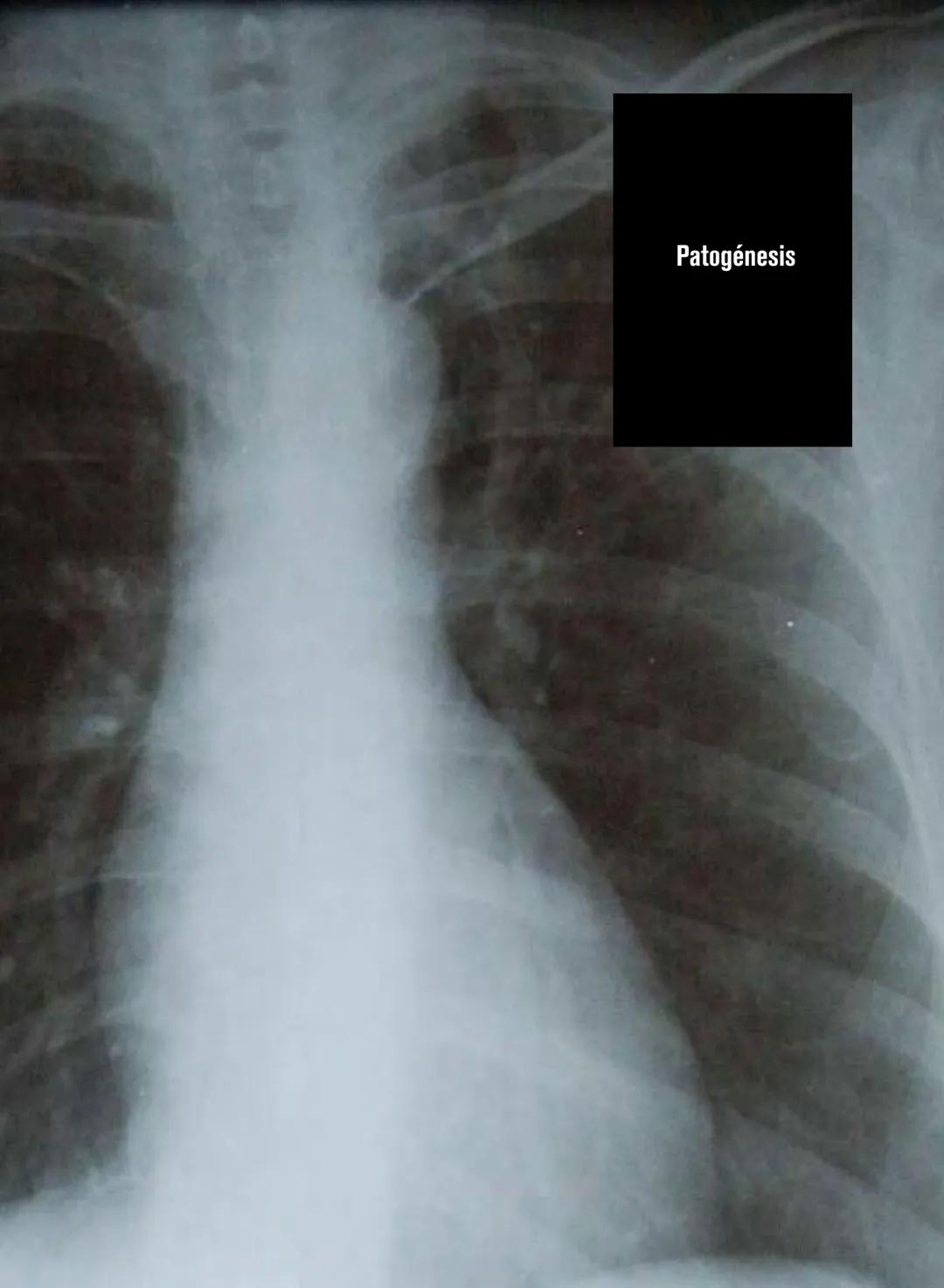Generalidades sobre la tuberculosis
La tuberculosis (TB) es una enfermedad causada por un or-
ganismo denominado Mycobacterium tuberculosis 