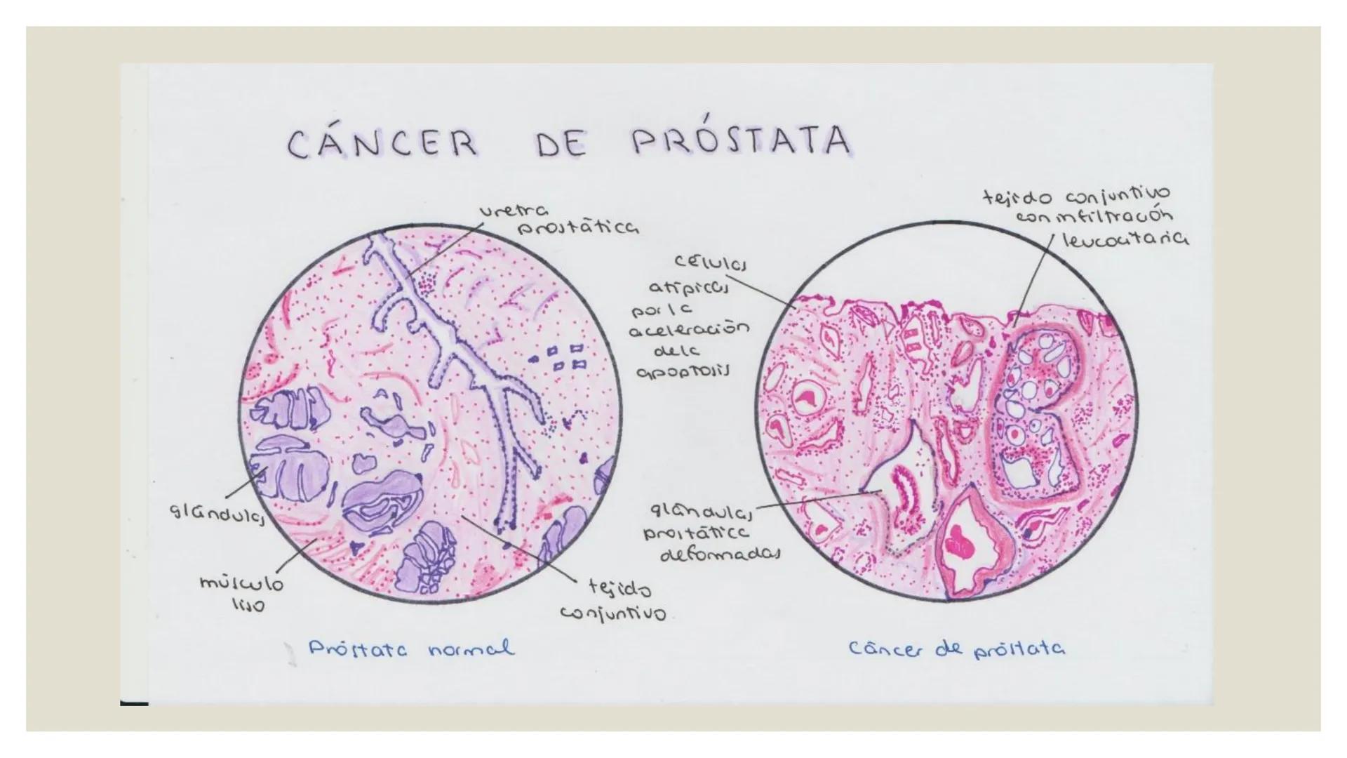 CANCER DE PROSTATA
DEFINICION
El cáncer de prostata ((ap) e, la proliferacón
descontrolada de lafcélula, prostáticas,
haciendo que se creen