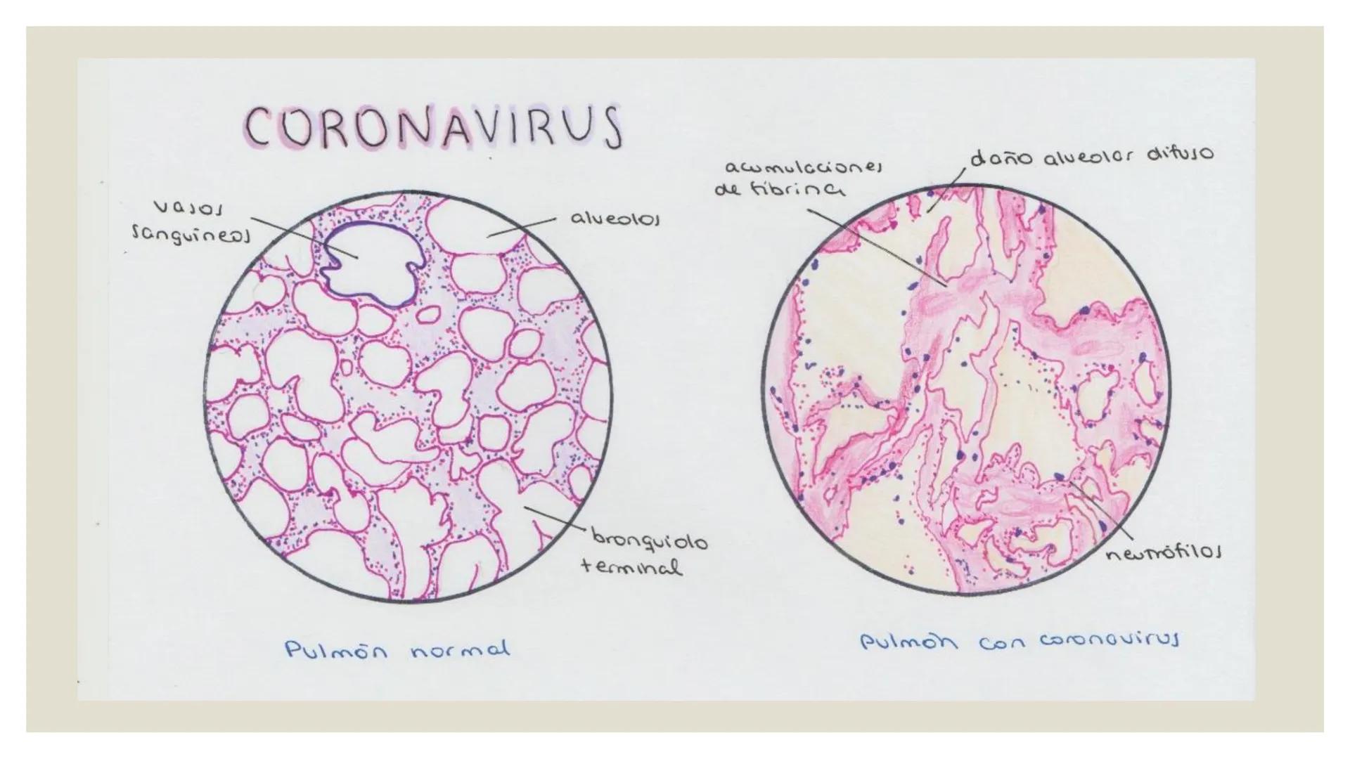 --- OCR Start ---
CORONAVIRUS
DEFINICIÓN
مم
El COVID-19 es una enfermedad causado por elSARS COV-2
tipos de animales debido asu
coronavirus