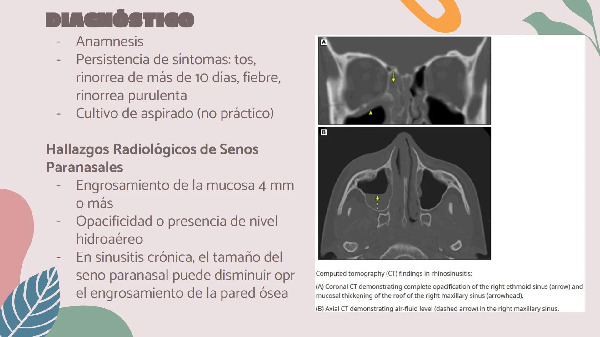 # OTITIS MEDIA
# AGUDA
IM Silvana Malú Garayar Sánchez DEFINICIÓN
Proceso séptico-
inflamatorio del
recubrimiento
mucoperióstico del oído