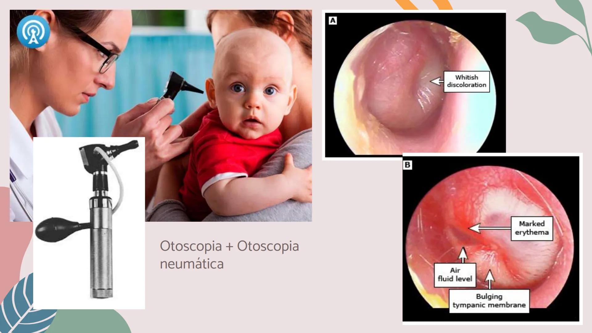 # OTITIS MEDIA
# AGUDA
IM Silvana Malú Garayar Sánchez DEFINICIÓN
Proceso séptico-
inflamatorio del
recubrimiento
mucoperióstico del oído