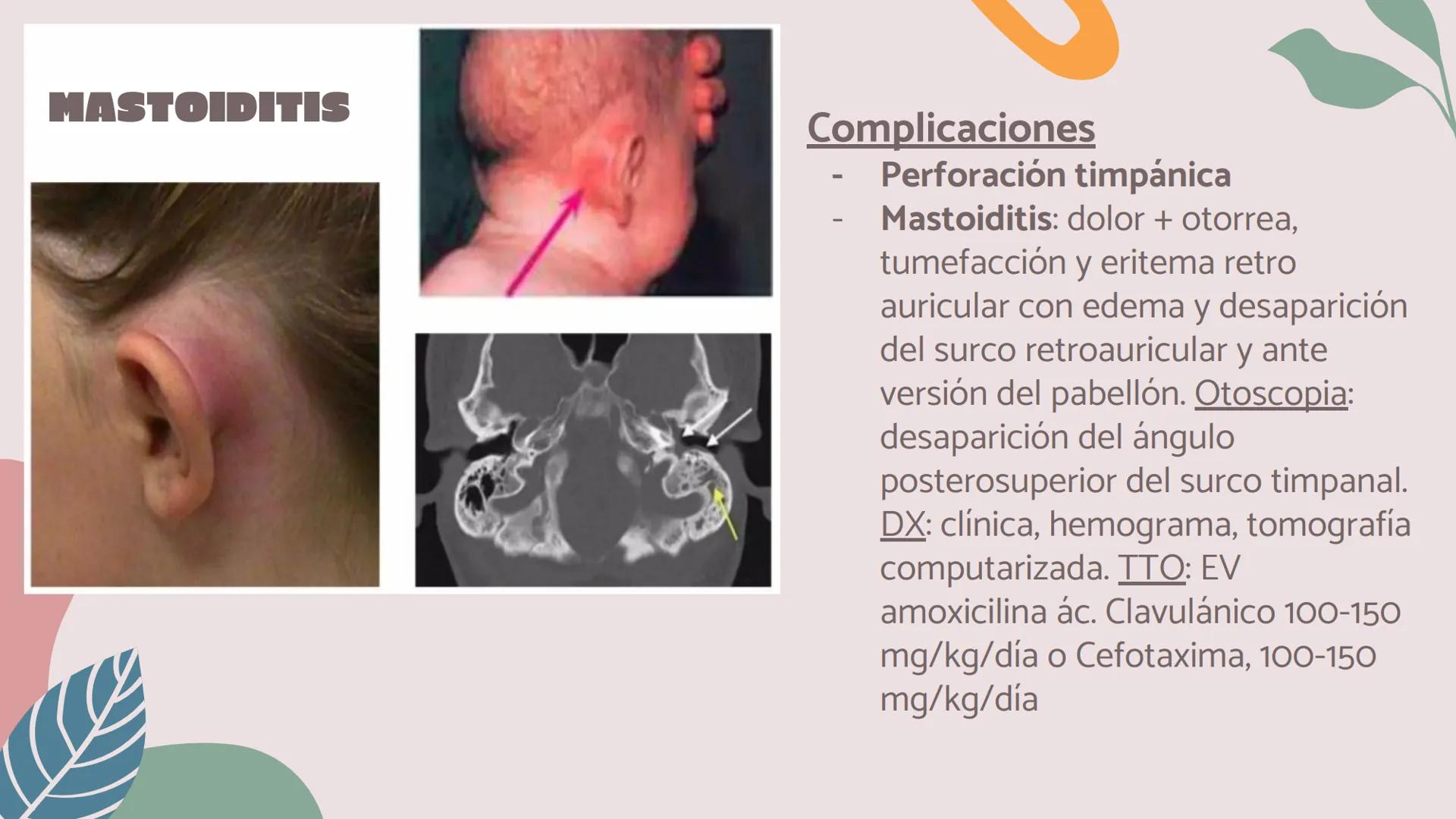 # OTITIS MEDIA
# AGUDA
IM Silvana Malú Garayar Sánchez DEFINICIÓN
Proceso séptico-
inflamatorio del
recubrimiento
mucoperióstico del oído